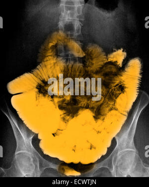 L'intestin grêle normal contraste baryté radiographie abdominale. Banque D'Images