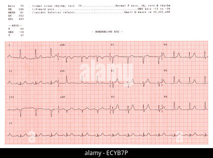 L'électrocardiogramme montre un rythme sinusal normal. Banque D'Images