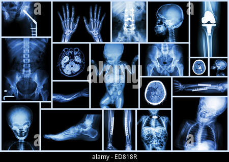 Collection X-ray de multiples organes de l'adulte et l'enfant & la chirurgie orthopédique et multiples cérébraux , arthrose , Fractu Banque D'Images