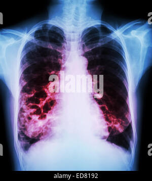 La Bronchiectasie' 'X-ray show : Poitrine de multiples kystes pulmonaires bleb et en raison de l'infection chronique Banque D'Images