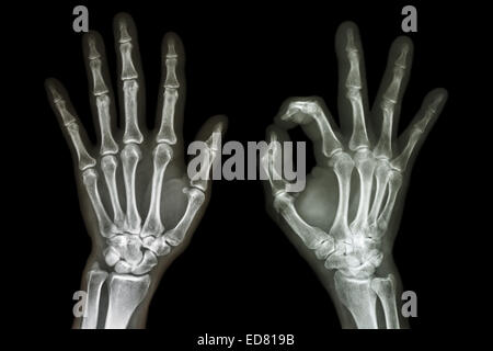 X-ray deux mains avec OK sign Banque D'Images