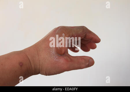 Homme gauche a un accident, bandage sur la gauche, Norfolk, Royaume-Uni Banque D'Images