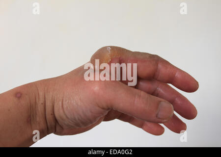 Homme gauche a un accident, bandage sur la gauche, Norfolk, Royaume-Uni Banque D'Images