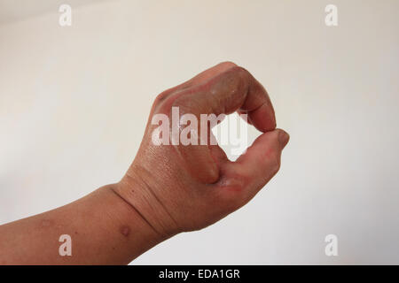 Homme gauche a un accident, bandage sur la gauche, Norfolk, Royaume-Uni Banque D'Images