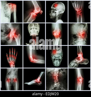 La collecte et de l'arthrite conjointe et d'avc ( skull head cou poitrine épaule épaule coude bras thorax avant-bras Poignet main fi Banque D'Images