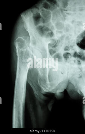 X-ray & pelvis hanche Fracture : tête du fémur (os de la cuisse) Banque D'Images