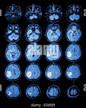 Cerveau IRM : tumeur au cerveau au lobe pariétal droit Banque D'Images
