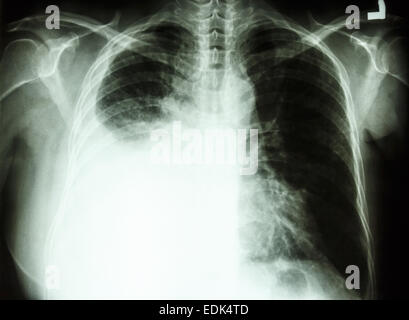 Film radiographie de la PA en position verticale : spectacle d'épanchement pleural au poumon droit due au cancer du poumon Banque D'Images