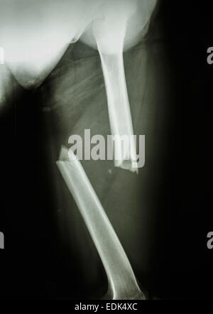 Film X-ray femur gauche(cuisse gauche) montrent une fracture complète du fémur et déplacer l'arbre Banque D'Images