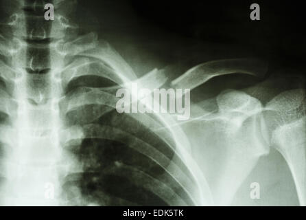 Film X-ray montrent une fracture complète 1/3 moyen de la clavicule gauche Banque D'Images