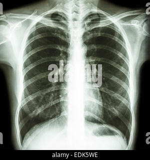 Film radiographie de la PA en position verticale : montrer la poitrine humaine normale Banque D'Images