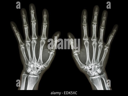 Film x-ray mains deux AP : montrer les mains humaines normales sur fond noir (isolé) Banque D'Images