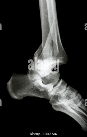 Film x-ray/AP la cheville Fracture tibia latéral : show et du péroné (os de la jambe) et la dislocation de la cheville Banque D'Images