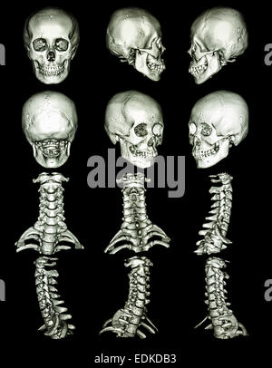 La tomodensitométrie (CT scan) avec 3D graphiques montrent le crâne humain normal et rachis cervical Banque D'Images