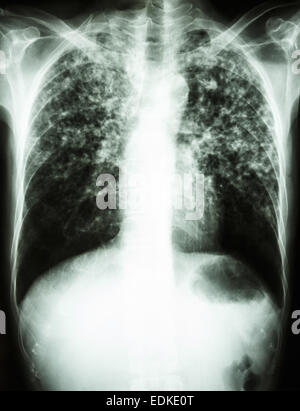 Film radiographie pulmonaire interstitielle pulmonaire montrent tant d'infiltrer en raison de l'infection à Mycobacterium tuberculosis (tuberculose pulmonaire) Banque D'Images