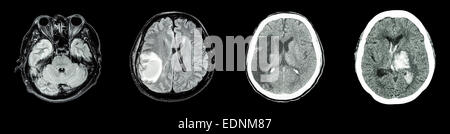 Collection de CT scan et cerveau maladie multiples (de gauche à droite : le fonctionnement normal du cerveau, tumeur au cerveau, l'infarctus cérébral,h intracérébrale Banque D'Images