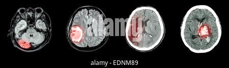 Collection de CT scan et cerveau maladie multiples (de gauche à droite : le fonctionnement normal du cerveau, tumeur au cerveau, l'infarctus cérébral,h intracérébrale Banque D'Images