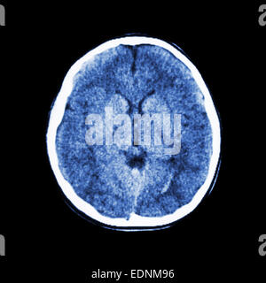 CT scan normal de cerveau (Computed tomography) Banque D'Images