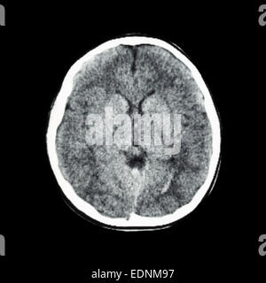 CT scan normal de cerveau (Computed tomography) Banque D'Images