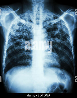 Le film 'La tuberculose pulmonaire La radiographie pulmonaire infiltration interstitielle montrent à la fois en raison de l'infection à Mycobacterium tuberculosis Banque D'Images