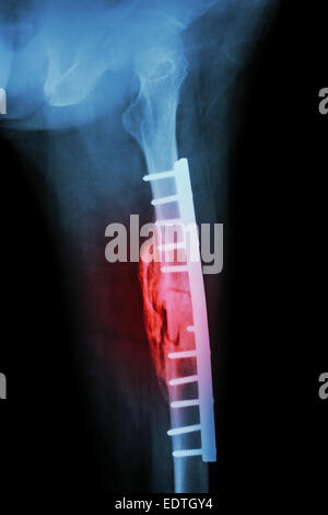 De l'arbre d'une fracture du fémur. Il a été opéré et la fixation interne par vis et plaque Banque D'Images