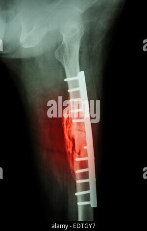 De l'arbre d'une fracture du fémur. Il a été opéré et la fixation interne par vis et plaque Banque D'Images