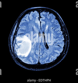 Cerveau IRM montrent : tumeur au cerveau droit au lobe pariétal du cerveau Banque D'Images