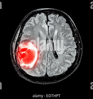 Cerveau IRM montrent : tumeur au cerveau droit au lobe pariétal du cerveau Banque D'Images