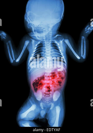 De l'entérite (X-ray de la maladie et de l'inflammation de l'intestin) Banque D'Images