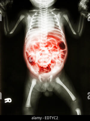 De l'entérite (X-ray de la maladie et de l'inflammation de l'intestin) Banque D'Images