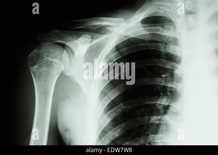 Film X-ray show moyen fracture clavicule droite Banque D'Images
