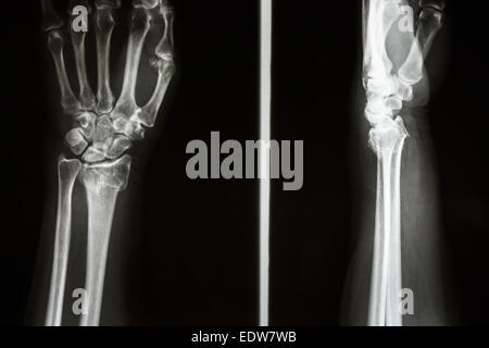 Film X-ray afficher la partie distale du radius fracture (fracture de Pouteau-Colles) (poignet) Banque D'Images