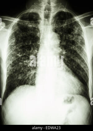 Film radiographie pulmonaire interstitielle pulmonaire montrent tant d'infiltrer en raison de l'infection à Mycobacterium tuberculosis (tuberculose pulmonaire) Banque D'Images