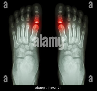 "L'arthrite rhumatoïde, l'arthrite goutteuse' X-ray l'enfant qui paie et de l'arthrite à l'articulation métatarsophalangienne du gros orteil (salon) Banque D'Images