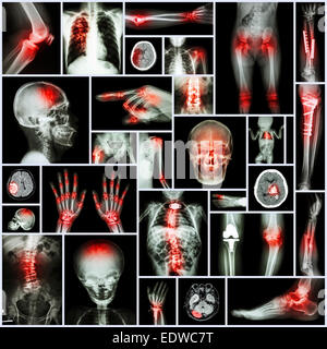 Collection X-ray partie des droits de l,opération orthopédique des fractures multiples (maladie,,la goutte,l'arthrite rhumatoïde, l'arthrose du genou,Str Banque D'Images