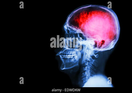 X-ray crâne et rachis cervical (latéral) avec 'Stroke' Banque D'Images