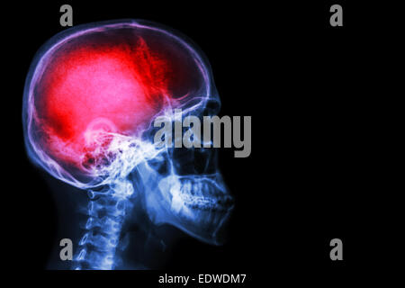 X-ray crâne et rachis cervical (latéral) avec 'Stroke' Banque D'Images