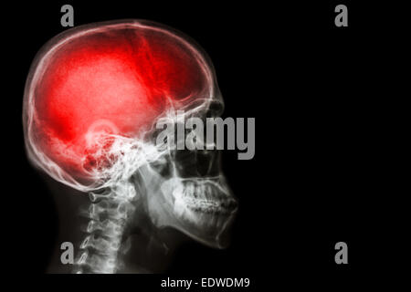 X-ray crâne et rachis cervical (latéral) avec 'Stroke' Banque D'Images