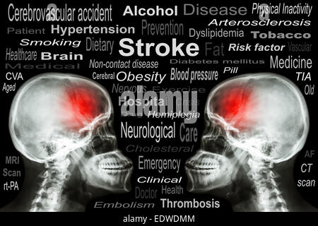 X-ray crâne avec 'Stroke' et texte médical Banque D'Images