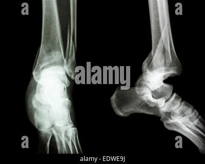 Film x-ray/AP la cheville : show latéral du tibia et du péroné distal de la fracture de jambe (os) et de la dislocation de la cheville Banque D'Images