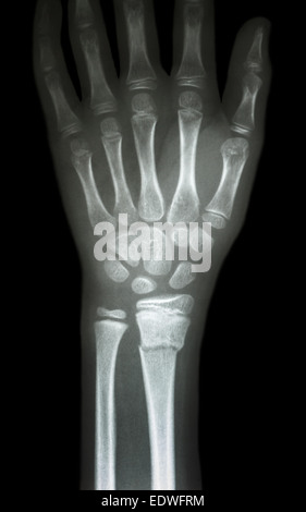 Fiilm x-ray show poignet du radius distal (fracture des os de l'avant-bras) Banque D'Images