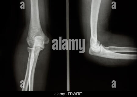 Film x-ray AP/coude : latérale du coude humain normal Banque D'Images