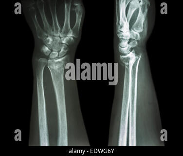 La partie distale du radius fracture (fracture de Pouteau-Colles) (poignet cassé) Banque D'Images