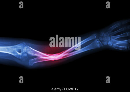 X-ray cubital fracture osseuse (os de l'avant-bras) Banque D'Images