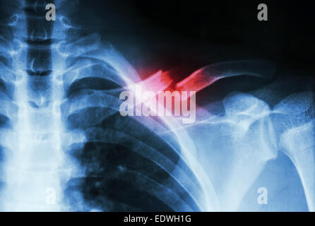 Film X-ray montrent une fracture complète 1/3 moyen de la clavicule gauche Banque D'Images