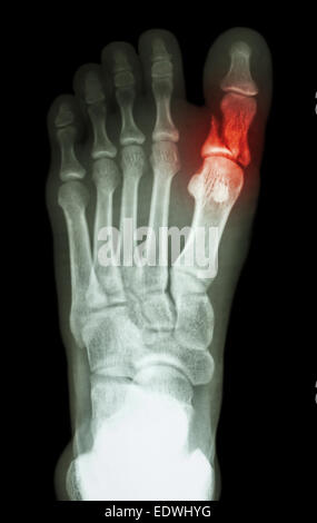 Film x-ray show à première phalange proximale fracture orteil Banque D'Images