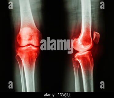 Film x-ray AP/GENOU Arthrose : latéral (Inflammation au genou) Banque D'Images