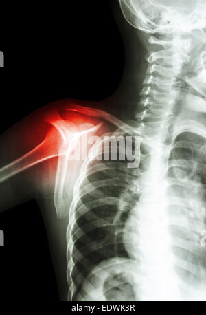 Film x-ray transcapula y voir l'épaule de l'enfant : spectacle et de l'arthrite à l'épaule Banque D'Images