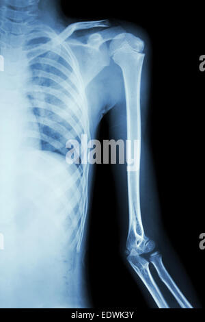 Film x-ray à l'épaule gauche Banque D'Images