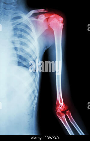 Film x-ray à l'épaule gauche et de l'arthrite à l'épaule et le coude Banque D'Images